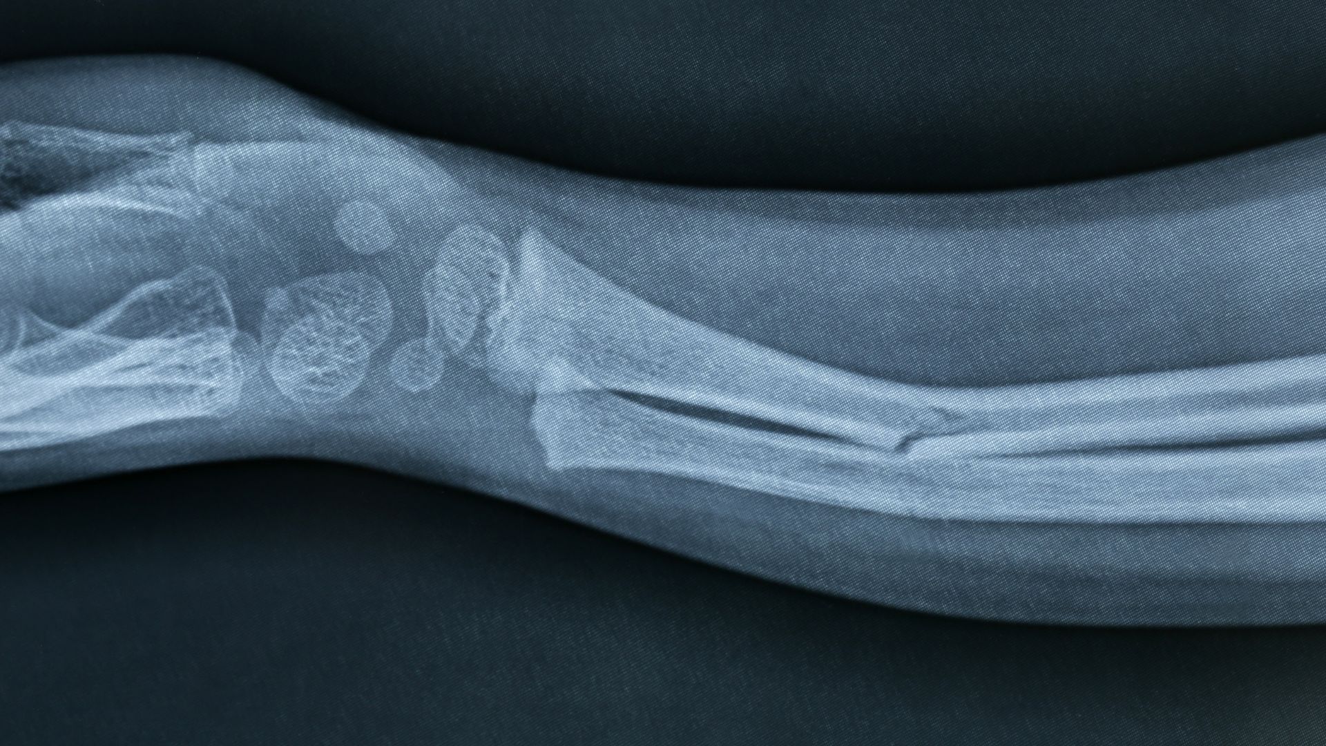 Common Injuries Resulting From Sidewalk Slip and Fall Accidents in Los Angeles, CA image